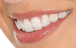 clear braces